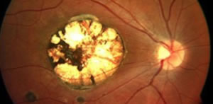 Toxoplasmose ocular