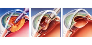 Cirurgia de Catarata com implante de lente intraocular